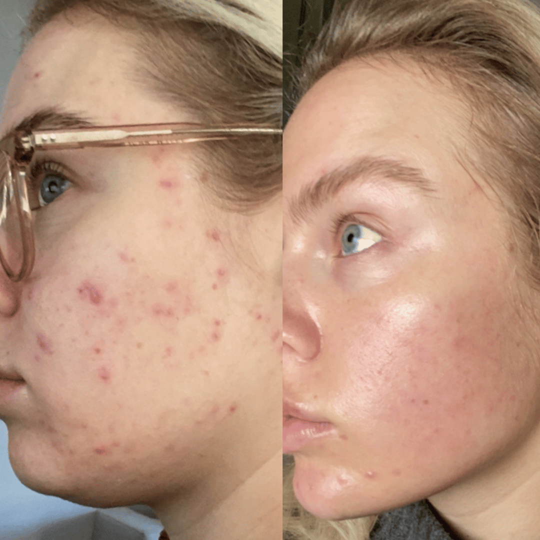 Before and after close up of skin