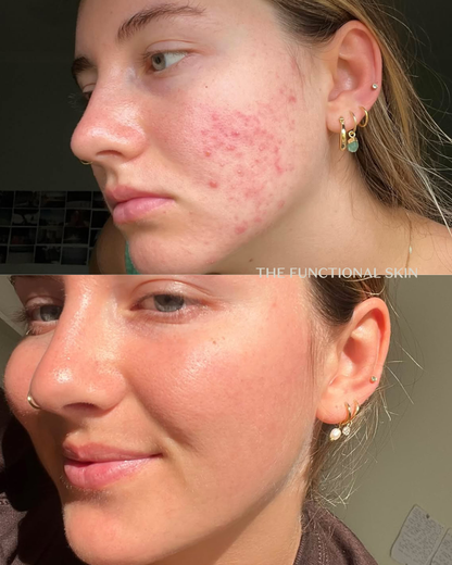 Before and after close up of skin 