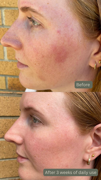 Before and after comparison of a woman's face with visible acne, set against a brick wall.